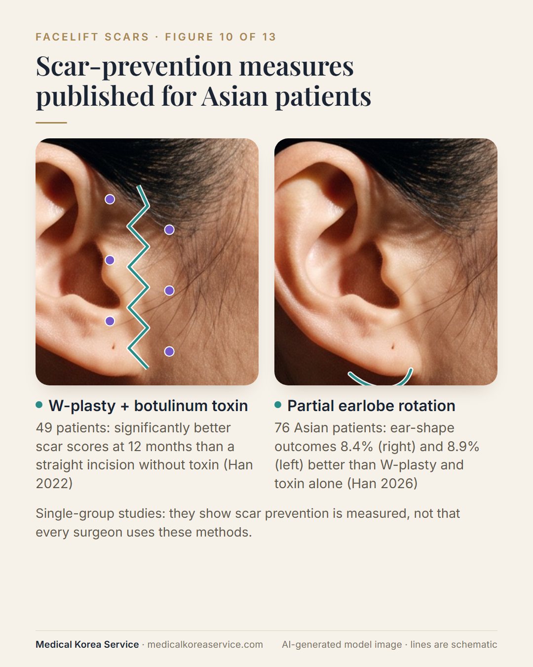 AI-generated model photo. Diagram of a straight incision versus a zig-zag W-plasty incision with toxin injection points, and an ear showing partial earlobe rotation
