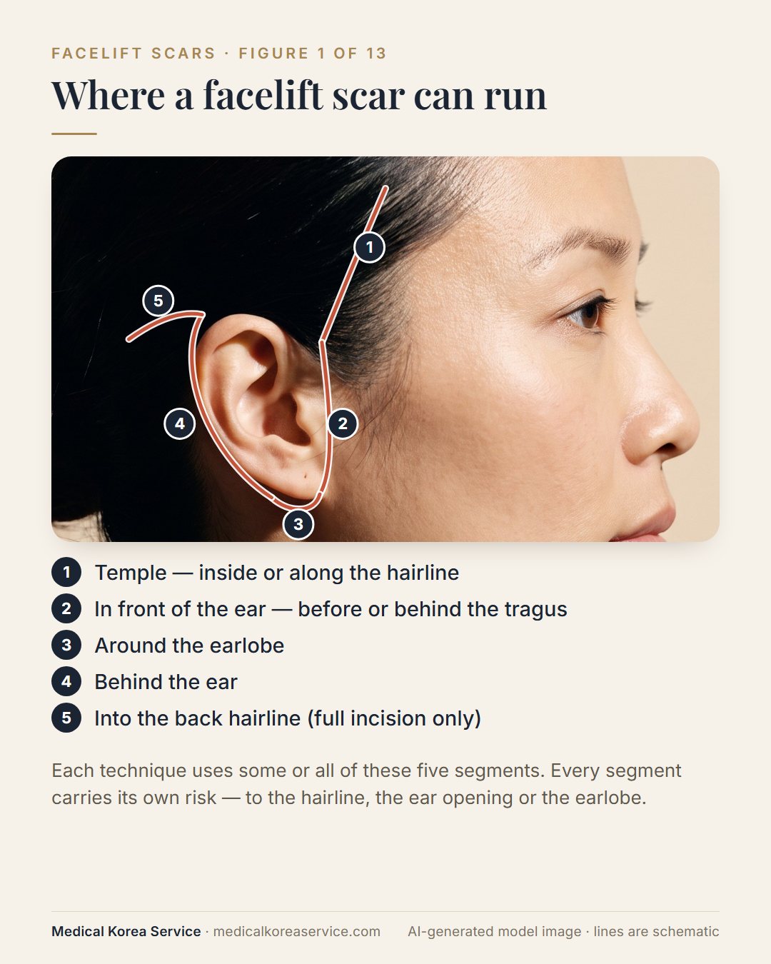 AI-generated model photo. Side-view diagram of the five segments a facelift incision can follow: temple hairline, in front of the ear, around the earlobe, behind the ear and into the back hairline