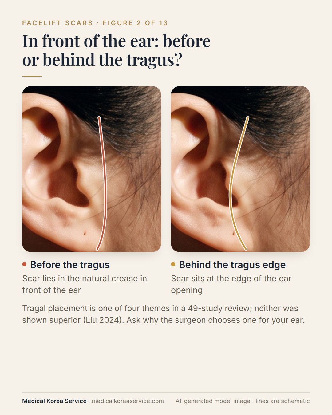 AI-generated model photo. Close-up ear diagram comparing a facelift incision placed in front of the tragus with one placed behind the tragus edge