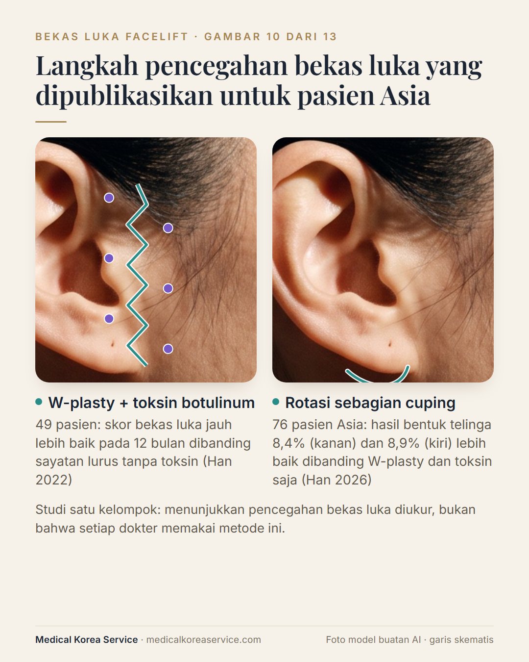Foto model buatan AI. Diagram sayatan lurus dibanding sayatan zig-zag W-plasty dengan titik suntikan toksin, dan telinga yang menunjukkan rotasi sebagian cuping