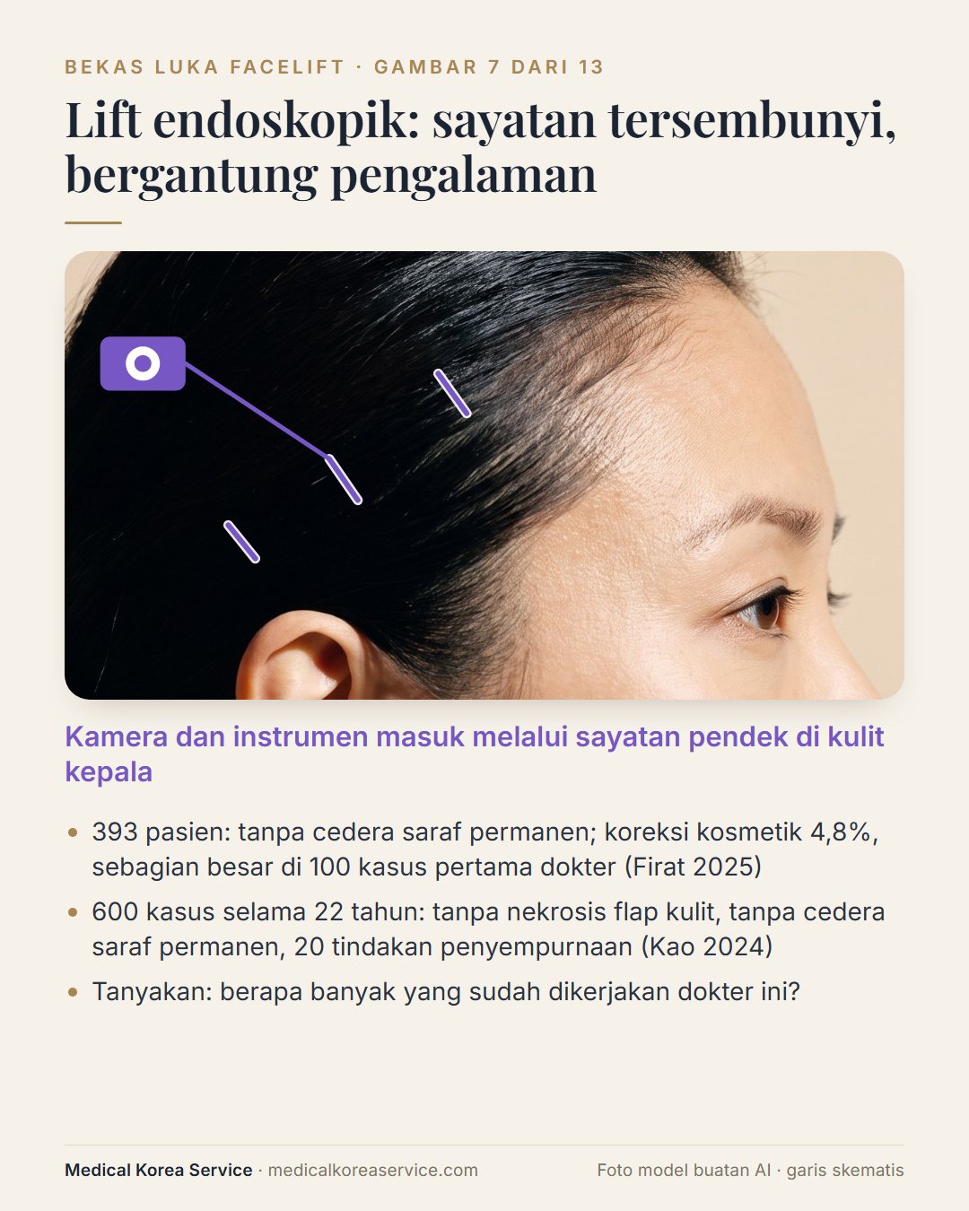 Foto model buatan AI. Diagram facelift endoskopik dengan sayatan pendek di kulit kepala dan kamera yang masuk melalui salah satunya