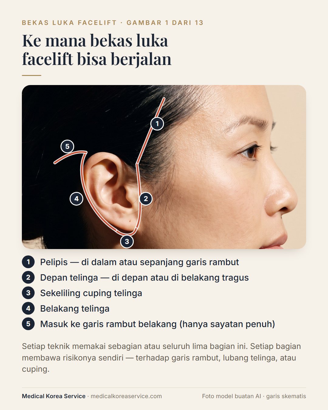 Foto model buatan AI. Diagram samping lima bagian yang dapat dilalui sayatan facelift: garis rambut pelipis, depan telinga, sekeliling cuping, belakang telinga, dan garis rambut belakang