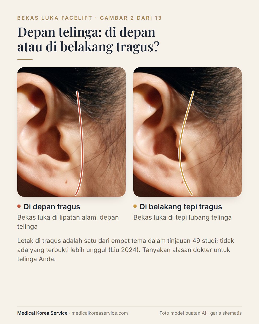 Foto model buatan AI. Diagram telinga yang membandingkan sayatan facelift di depan tragus dengan sayatan di belakang tepi tragus