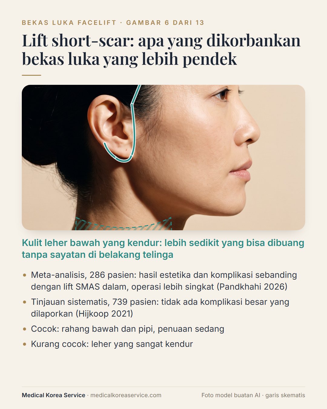 Foto model buatan AI. Diagram facelift short-scar yang berhenti di cuping, dengan leher bawah diarsir untuk menunjukkan kulit leher kendur yang dibuang lebih sedikit
