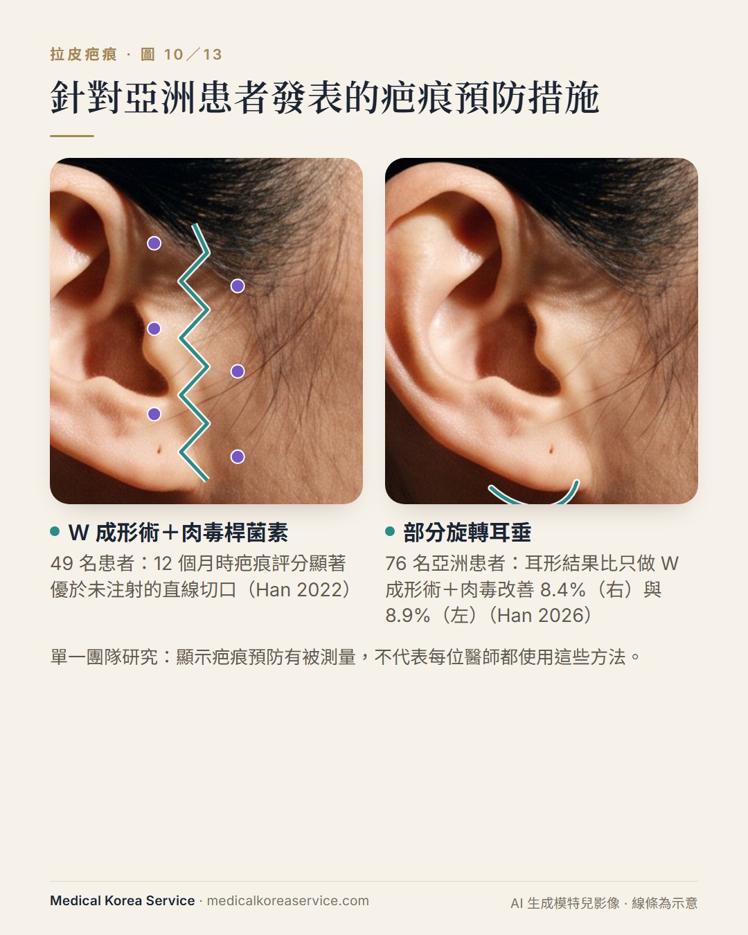 AI 生成的模特兒照片。示意圖：直線切口對比鋸齒狀 W 成形術切口與肉毒注射點，以及部分旋轉耳垂的耳朵