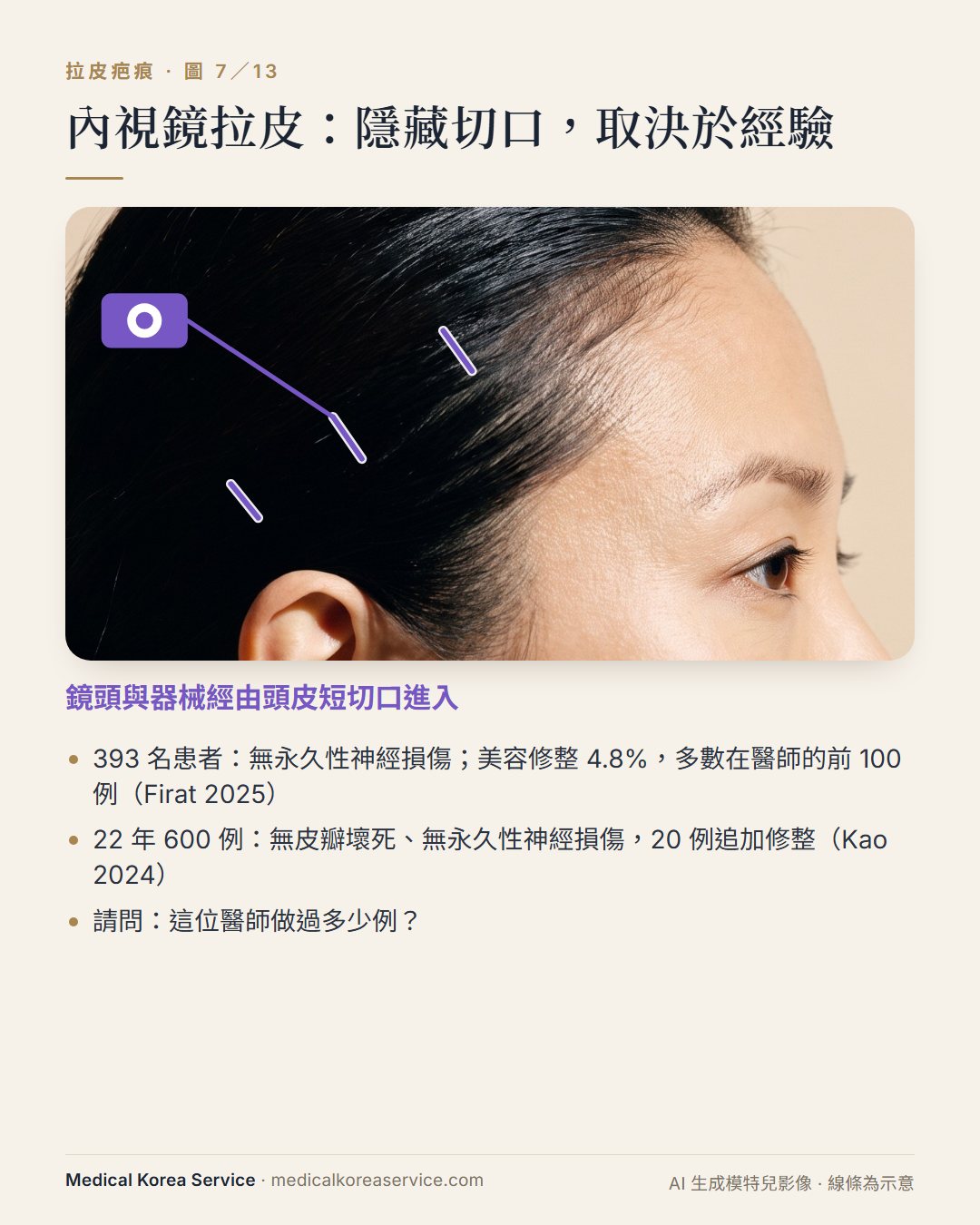 AI 生成的模特兒照片。內視鏡拉皮示意圖：頭皮內的短切口，以及由其中一個切口進入的鏡頭