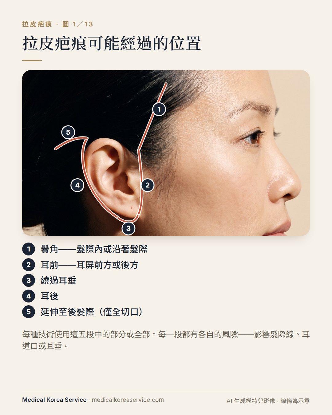 AI 生成的模特兒照片。側臉示意圖：拉皮切口可能經過的五段——鬢角髮際、耳前、耳垂周圍、耳後與後髮際