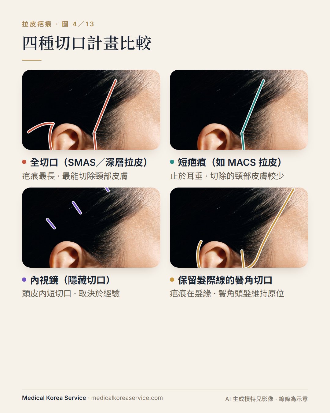 AI 生成的模特兒照片。四張側臉示意圖：比較全切口、MACS 短疤痕、內視鏡與保留髮際線的拉皮切口路徑