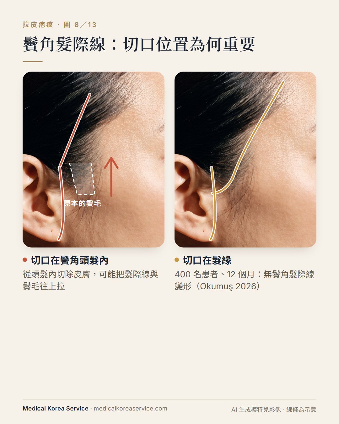 AI 生成的模特兒照片。兩張示意圖：比較在鬢角頭髮內的切口（可能讓髮際線與鬢毛上移）與位於髮緣的保留髮際線切口
