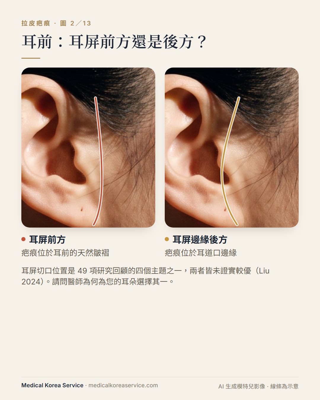 AI 生成的模特兒照片。耳朵特寫示意圖：比較耳屏前方與耳屏邊緣後方的拉皮切口位置