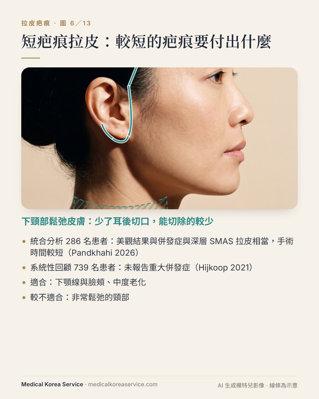 AI 生成的模特兒照片。短疤痕拉皮示意圖：切口止於耳垂，下頸部以斜線標示能切除的鬆弛皮膚較少