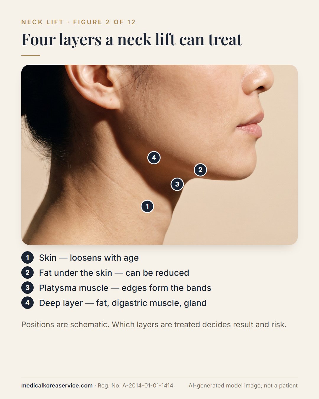 AI-generated model photo. Profile of a woman with four numbered points on the neck: skin, fat under the skin, platysma muscle, and the deep layer with digastric muscle and submandibular gland