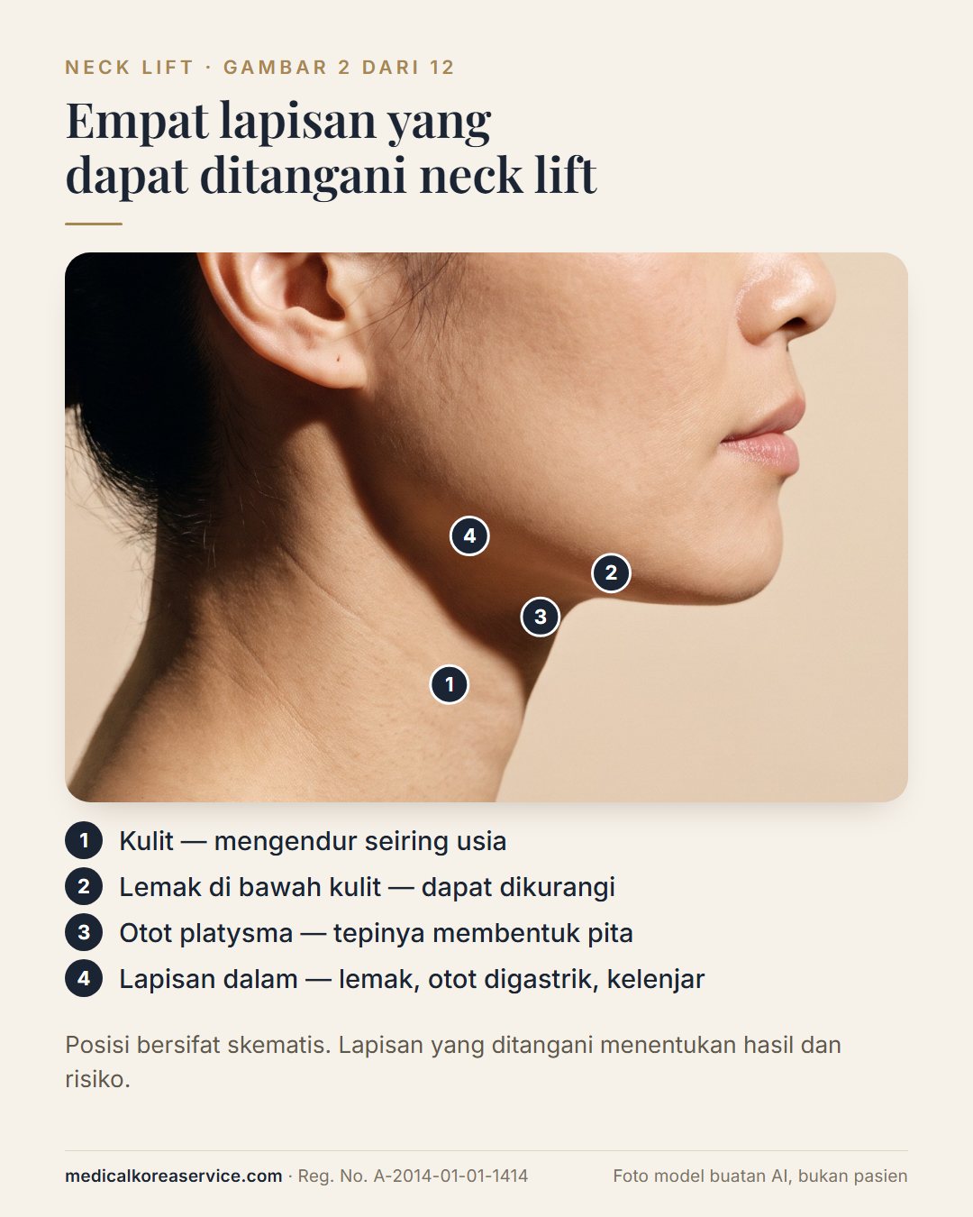 Foto model buatan AI. Profil seorang perempuan dengan empat titik bernomor di leher: kulit, lemak di bawah kulit, otot platysma, dan lapisan dalam berisi otot digastrik dan kelenjar submandibula