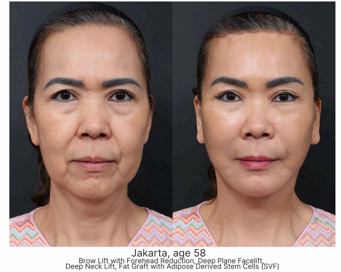 Brow Lift + Deep Plane Facelift + SVF Fat Graft — Jakarta patient, age 58 — Surgeon: Dr. Min-Hee Ryu — front view