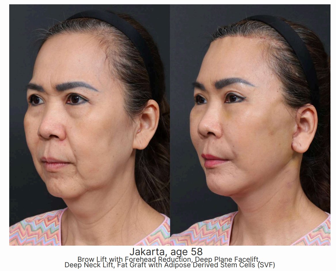 Brow Lift + Deep Plane Facelift + SVF Fat Graft — Jakarta patient, age 58 — Surgeon: Dr. Min-Hee Ryu — three-quarter view