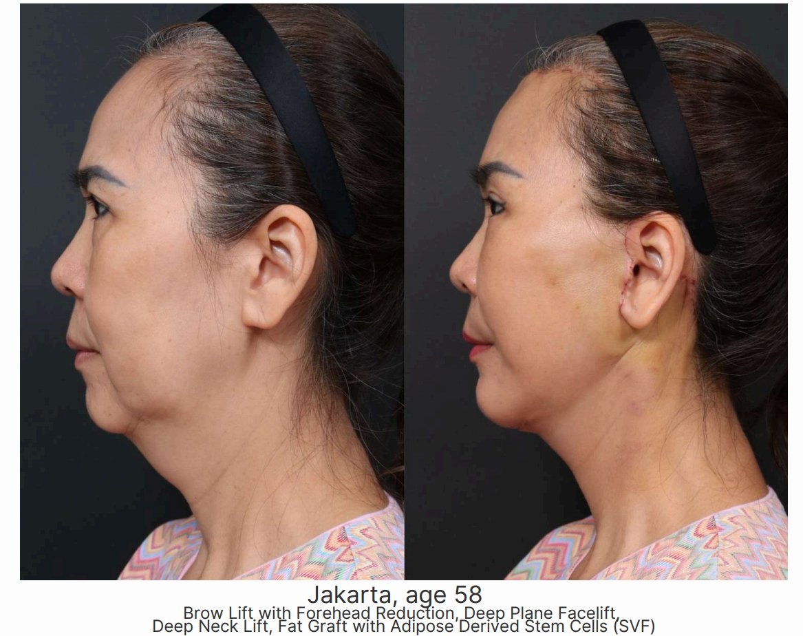 Brow Lift + Deep Plane Facelift + SVF Fat Graft — Jakarta patient, age 58 — Surgeon: Dr. Min-Hee Ryu — side profile view