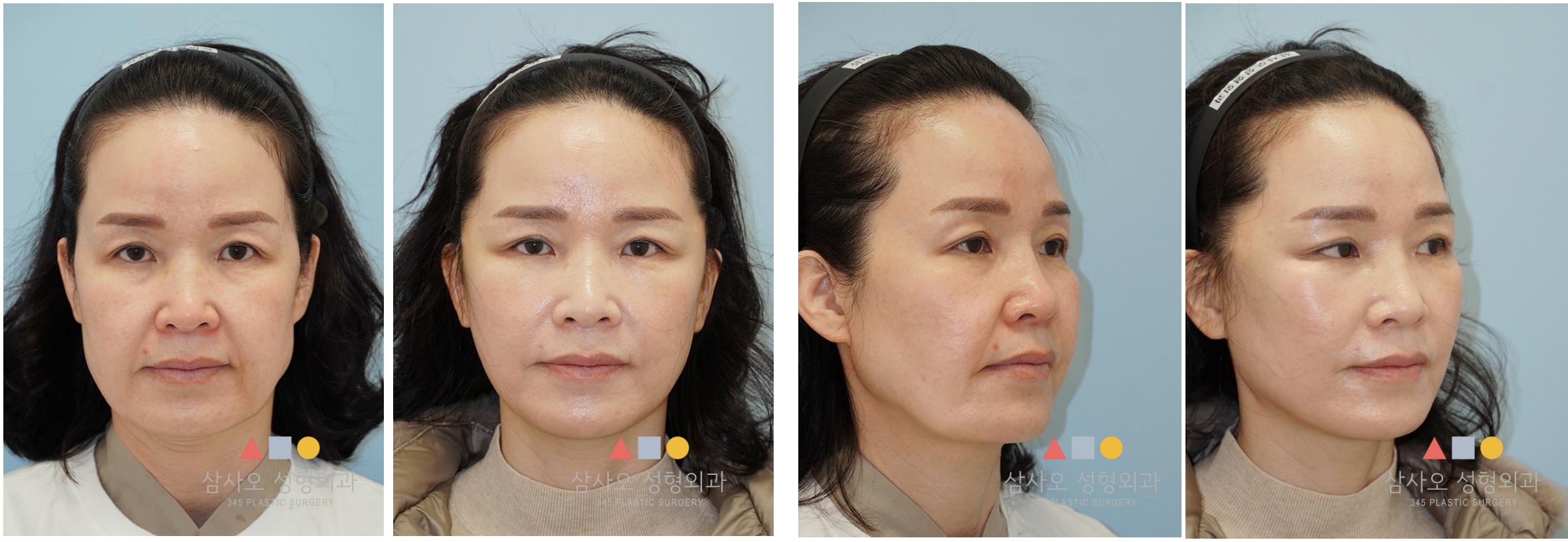 Minimal Incision Lifting Korea facelift — Surgeon: Dr. Kyunam Han — multi-angle before and after