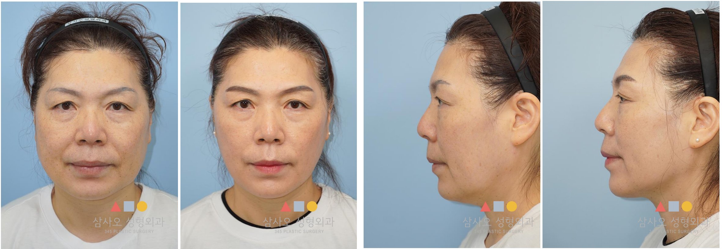Minimal Incision Lifting Korean facelift — Surgeon: Dr. Kyunam Han — second case multi-angle view