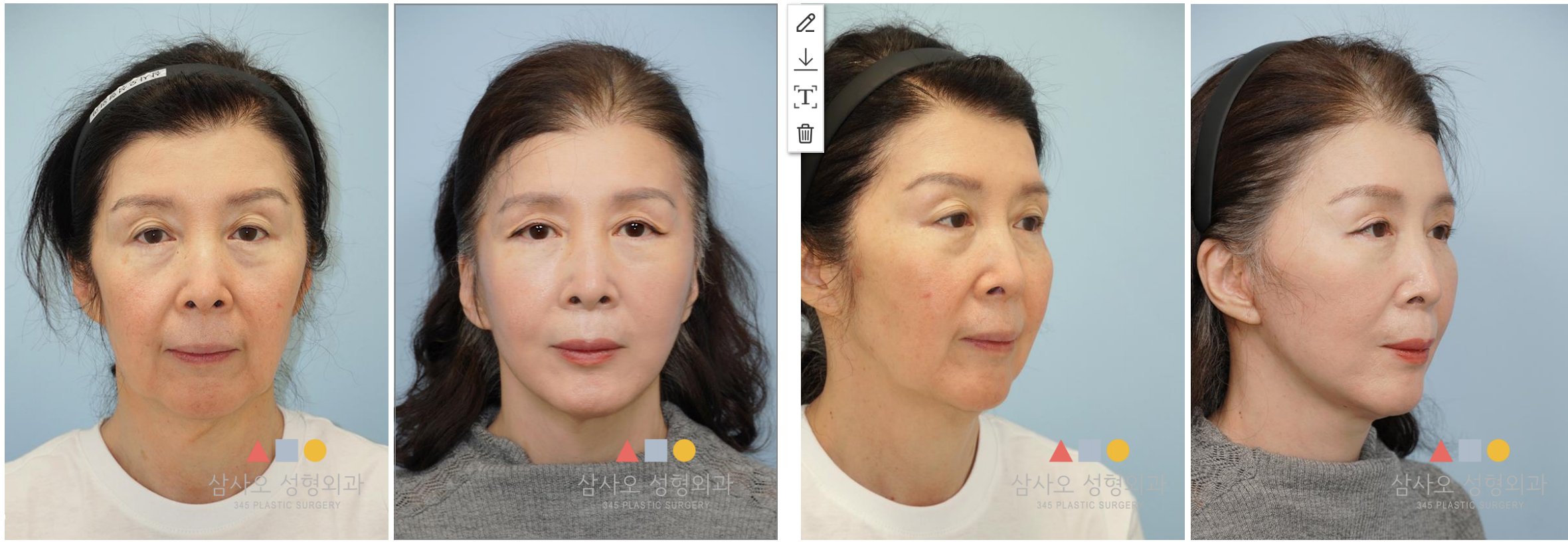 Face Lift + Neck Lift + Upper Blepharoplasty Korea — Surgeon: Dr. Kyunam Han — combined procedure result