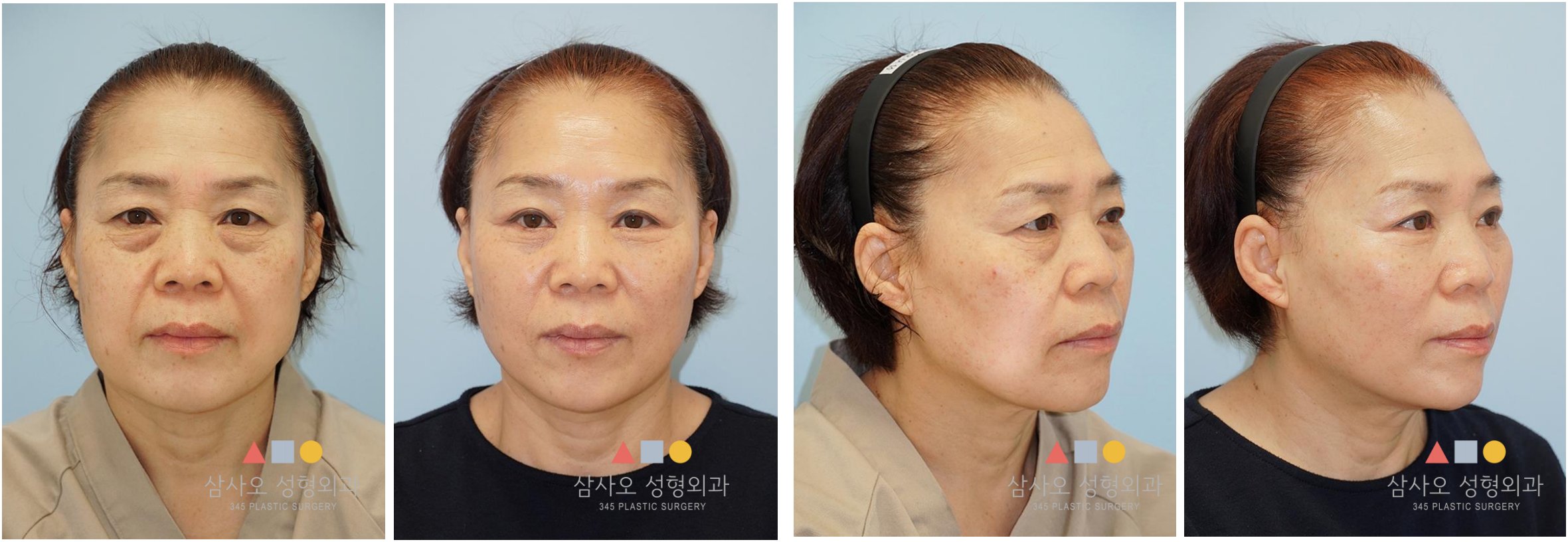 Minimal Incision Lifting + Upper and Lower Blepharoplasty Korea — Surgeon: Dr. Kyunam Han — combined facial rejuvenation