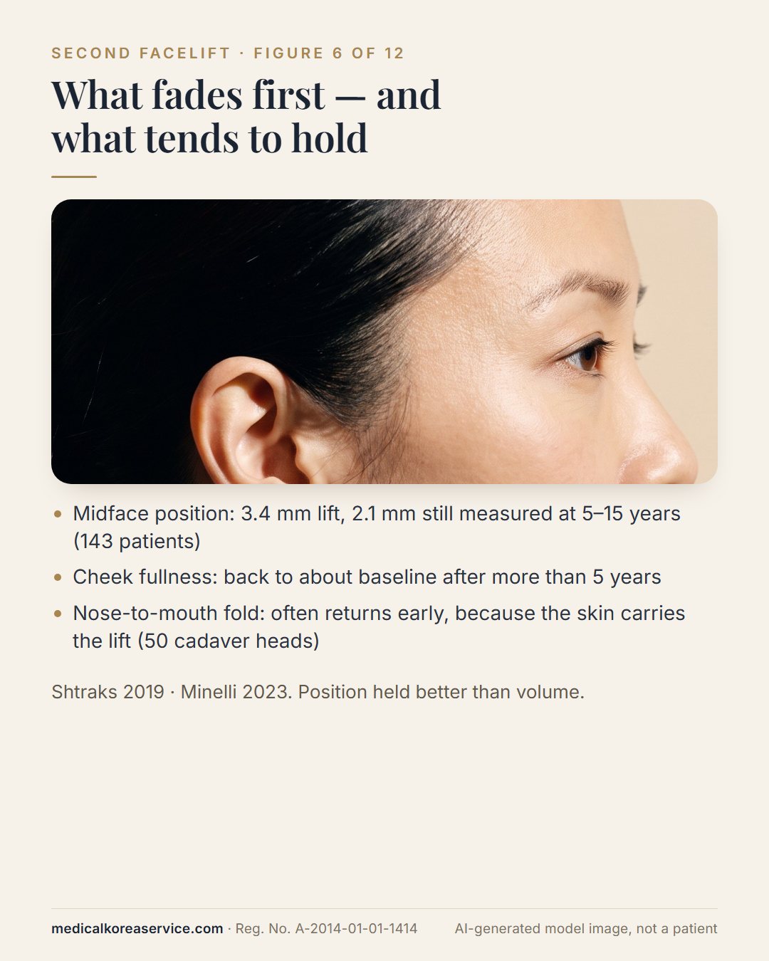 AI-generated model photo. Side profile with three notes: midface lift of 3.4 mm with 2.1 mm kept at 5 to 15 years, cheek fullness back to baseline, nasolabial fold returning early