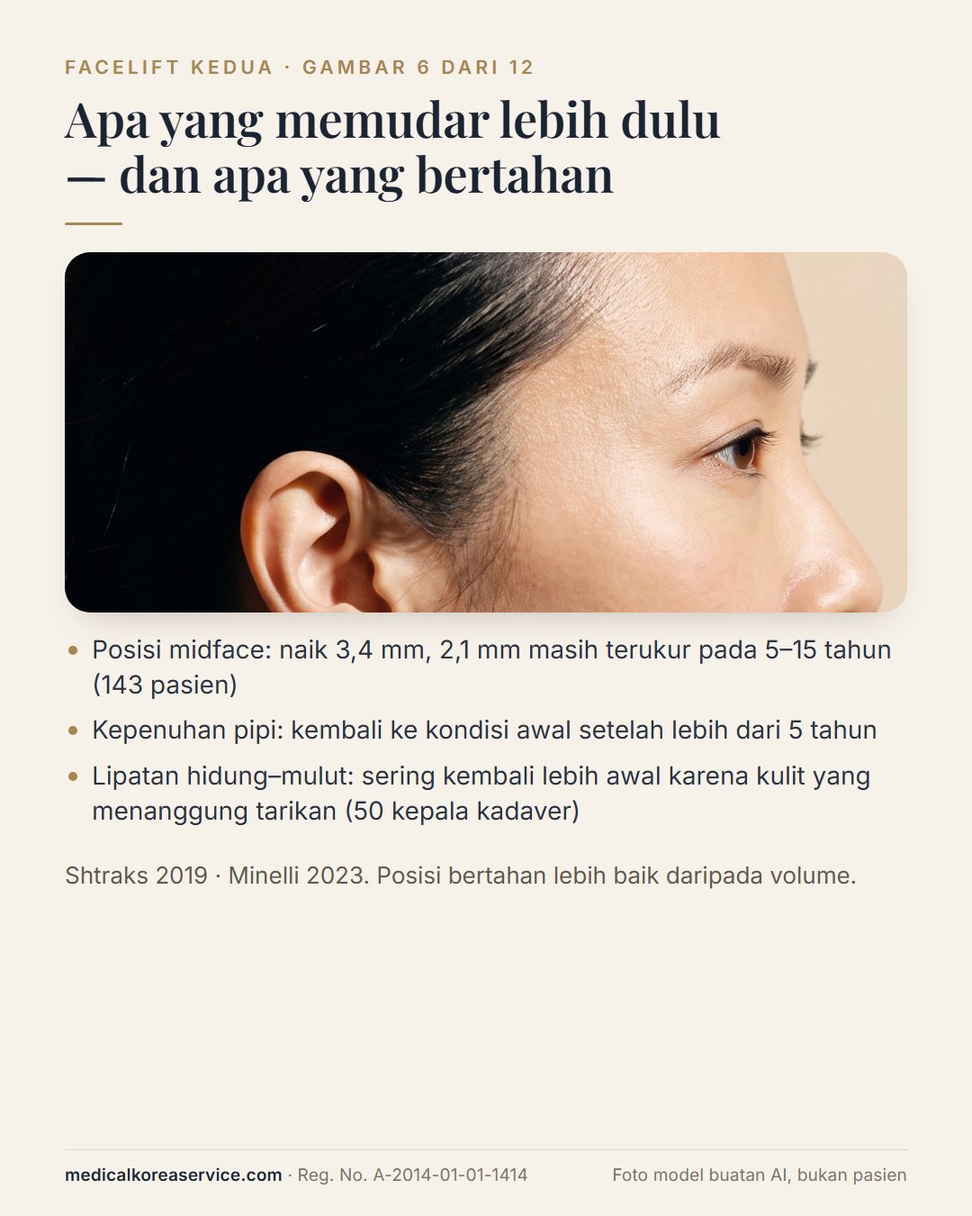 Foto model buatan AI. Profil samping dengan tiga catatan: lift midface 3,4 mm dengan 2,1 mm bertahan 5–15 tahun, kepenuhan pipi kembali, lipatan nasolabial kembali lebih awal