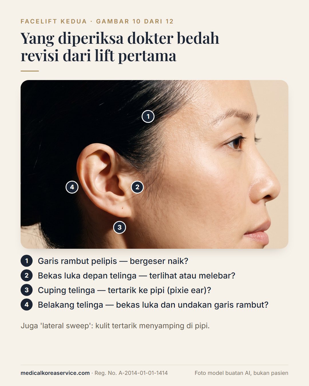 Foto model buatan AI. Profil samping dengan empat titik bernomor yang diperiksa dokter bedah revisi: garis rambut pelipis, bekas luka depan telinga, pixie ear, bekas luka belakang telinga