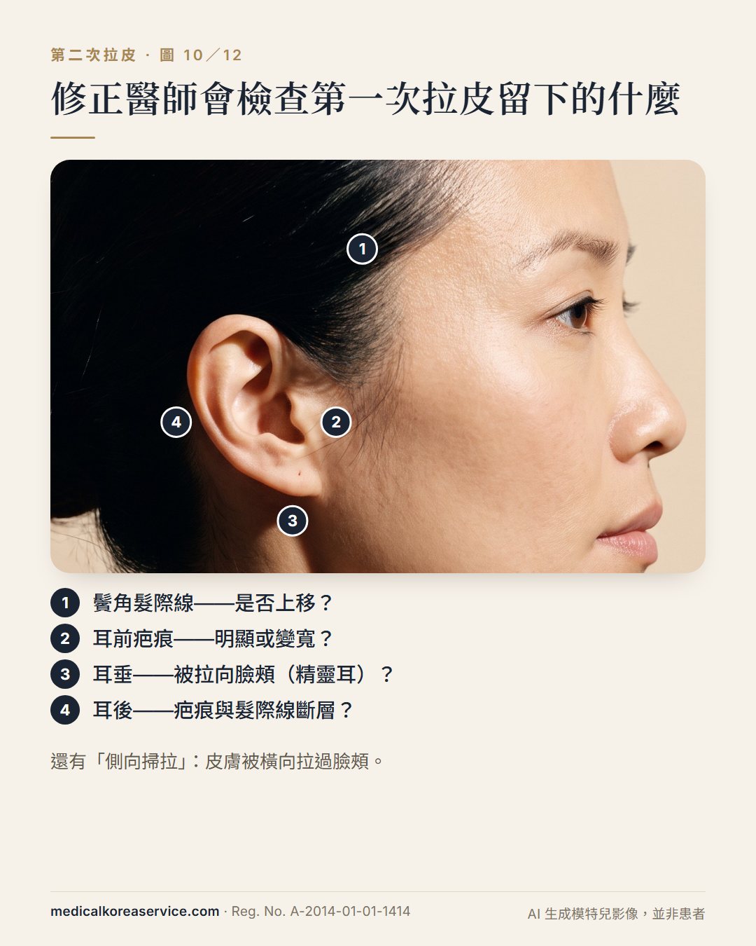 AI 生成的模特兒照片。側臉照標示修正醫師檢查的四處：鬢角髮際線、耳前疤痕、精靈耳、耳後疤痕