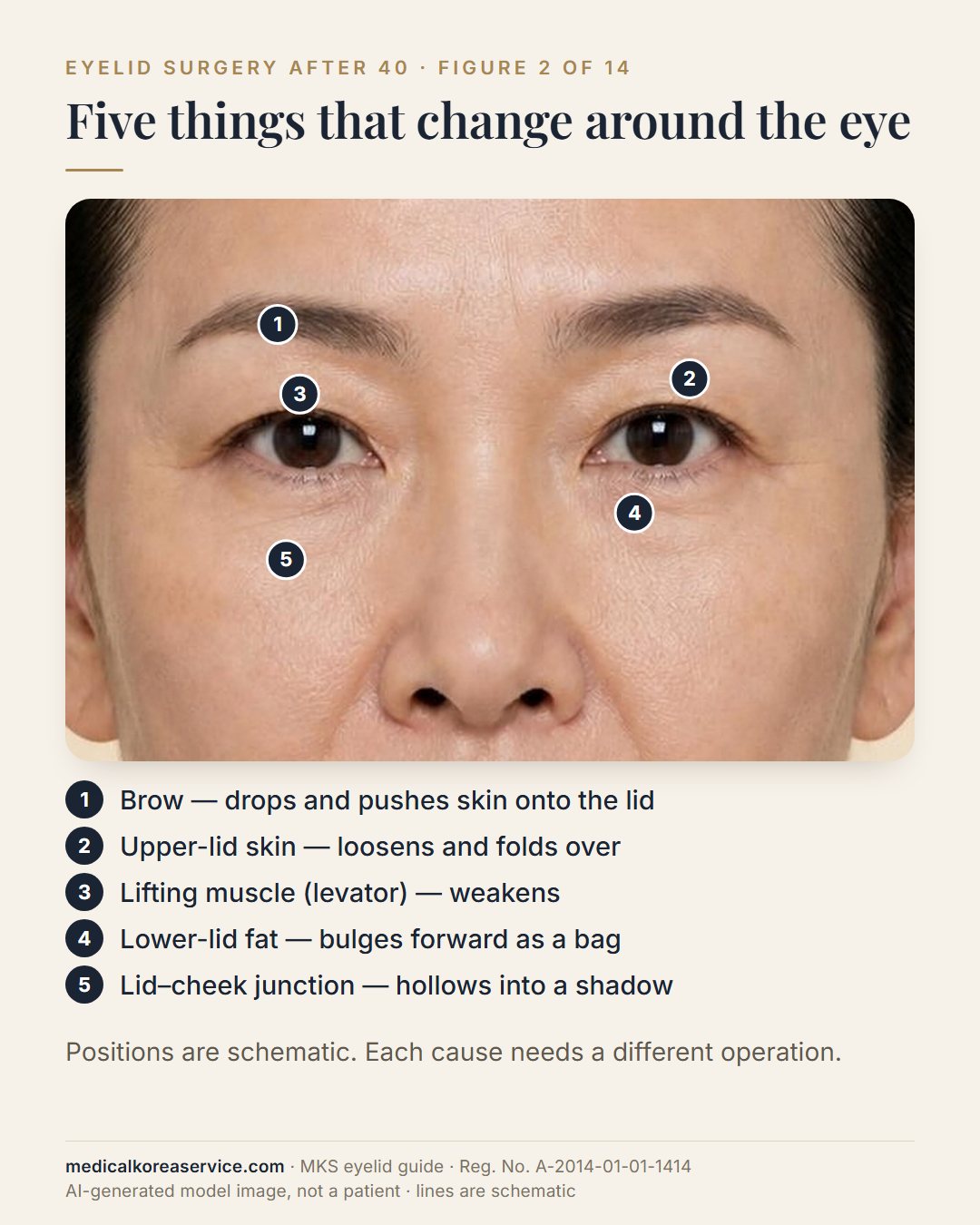 AI-generated model photo. Close view of the eyes with five numbered points: brow, upper-lid skin, levator muscle, lower-lid fat and the lid–cheek junction
