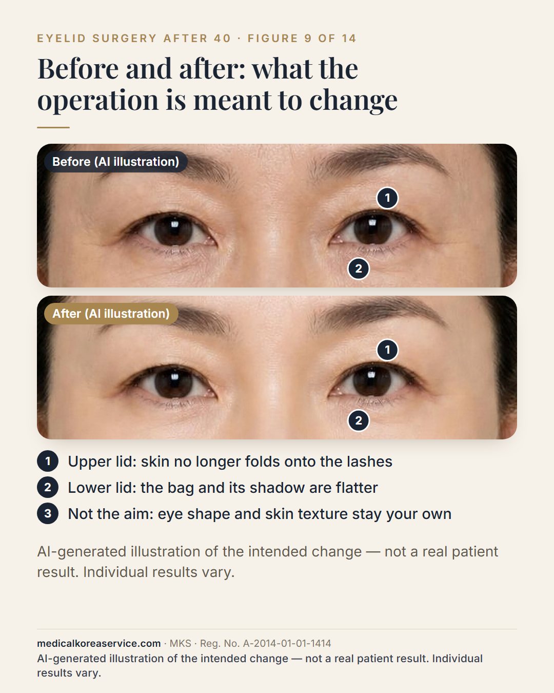 AI-generated model photo. Two views of both eyes of the same model, labelled Before and After, with numbered points on the upper lid and the lower lid: upper-lid skin no longer folds onto the lashes, and the lower-lid bag and shadow are flatter The before and after images are an AI-generated illustration of the intended change, not a real patient result.