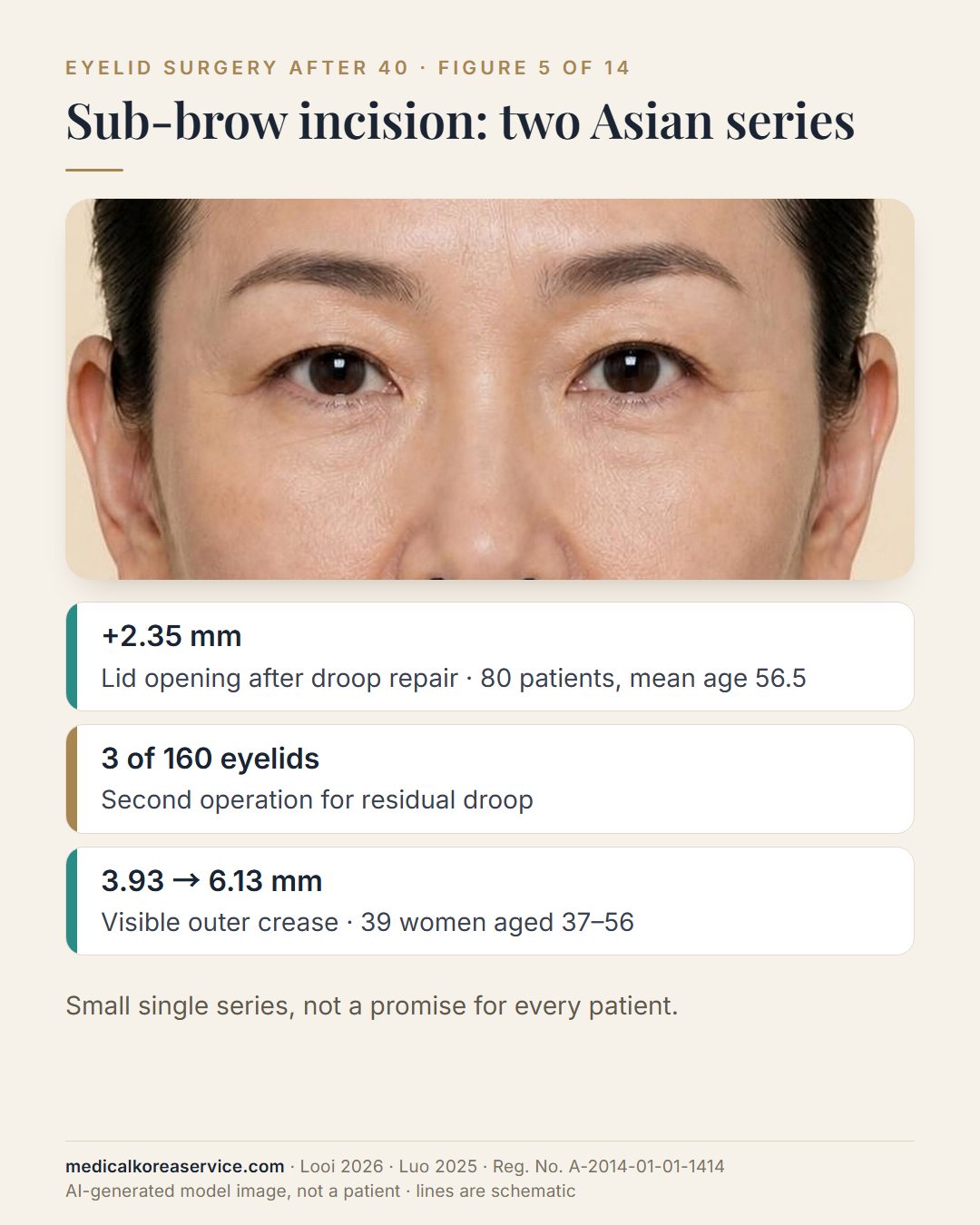 AI-generated model photo. Three results of sub-brow incision surgery in Asian patients beside a portrait: lid opening plus 2.35 mm in 80 patients, 3 of 160 eyelids reoperated, outer crease from 3.93 to 6.13 mm in 39 women