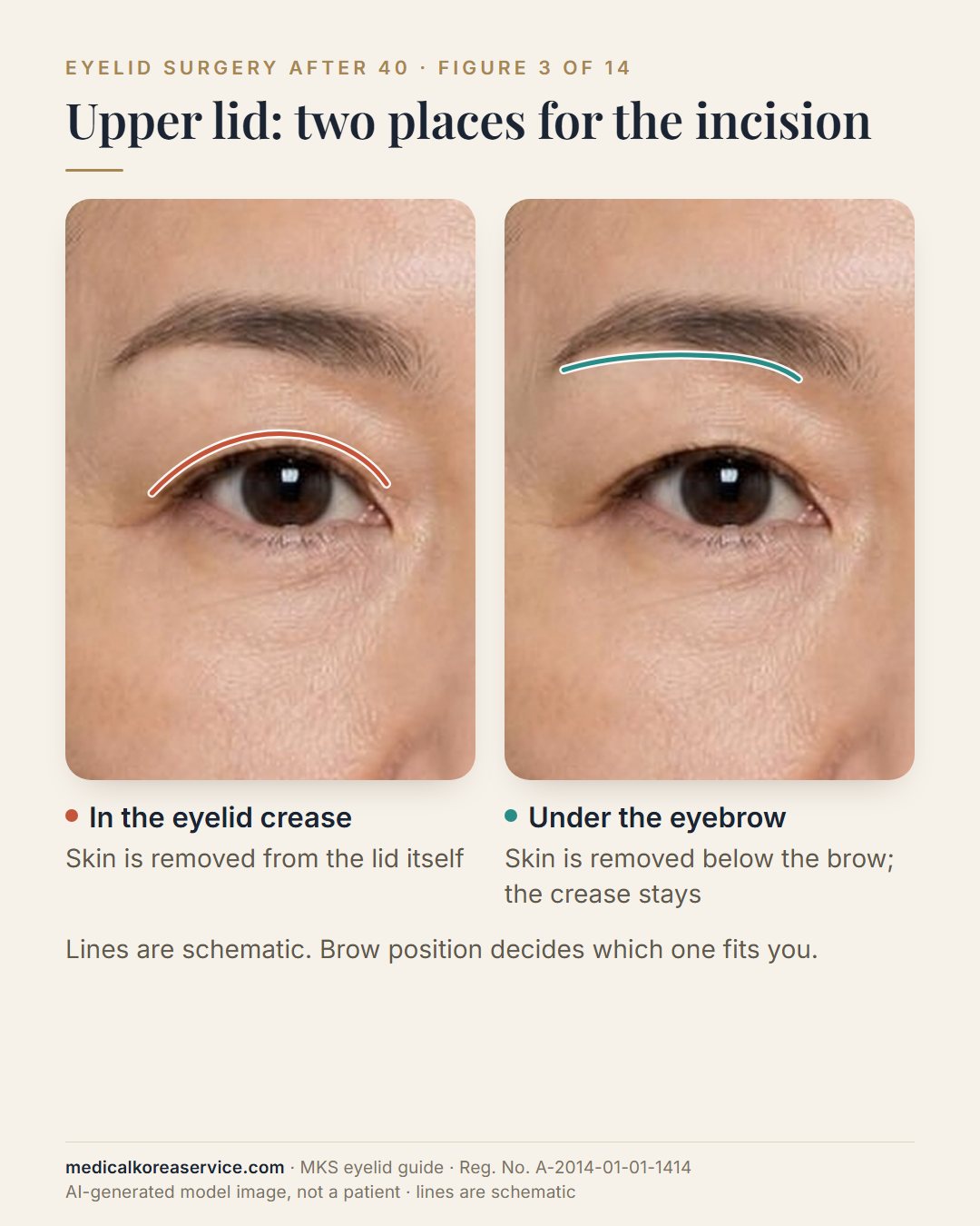 AI-generated model photo. Two views of the same eye comparing upper-eyelid incision positions: a line in the eyelid crease and a line just under the eyebrow