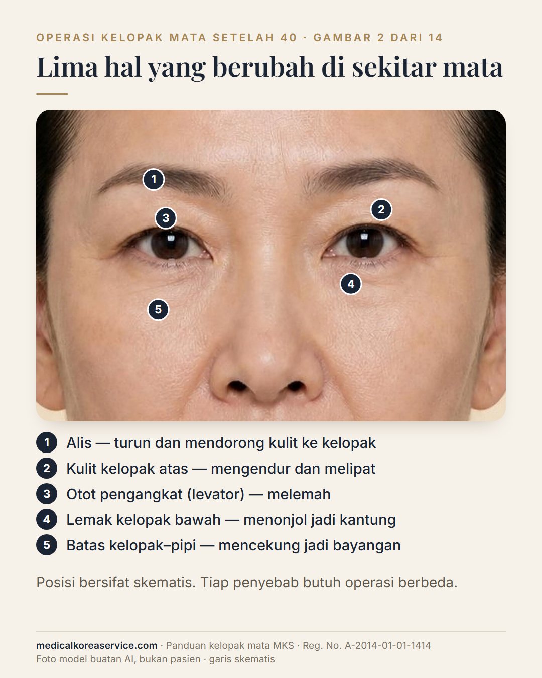 Foto model buatan AI. Tampilan dekat mata dengan lima titik bernomor: alis, kulit kelopak atas, otot levator, lemak kelopak bawah, dan batas kelopak–pipi