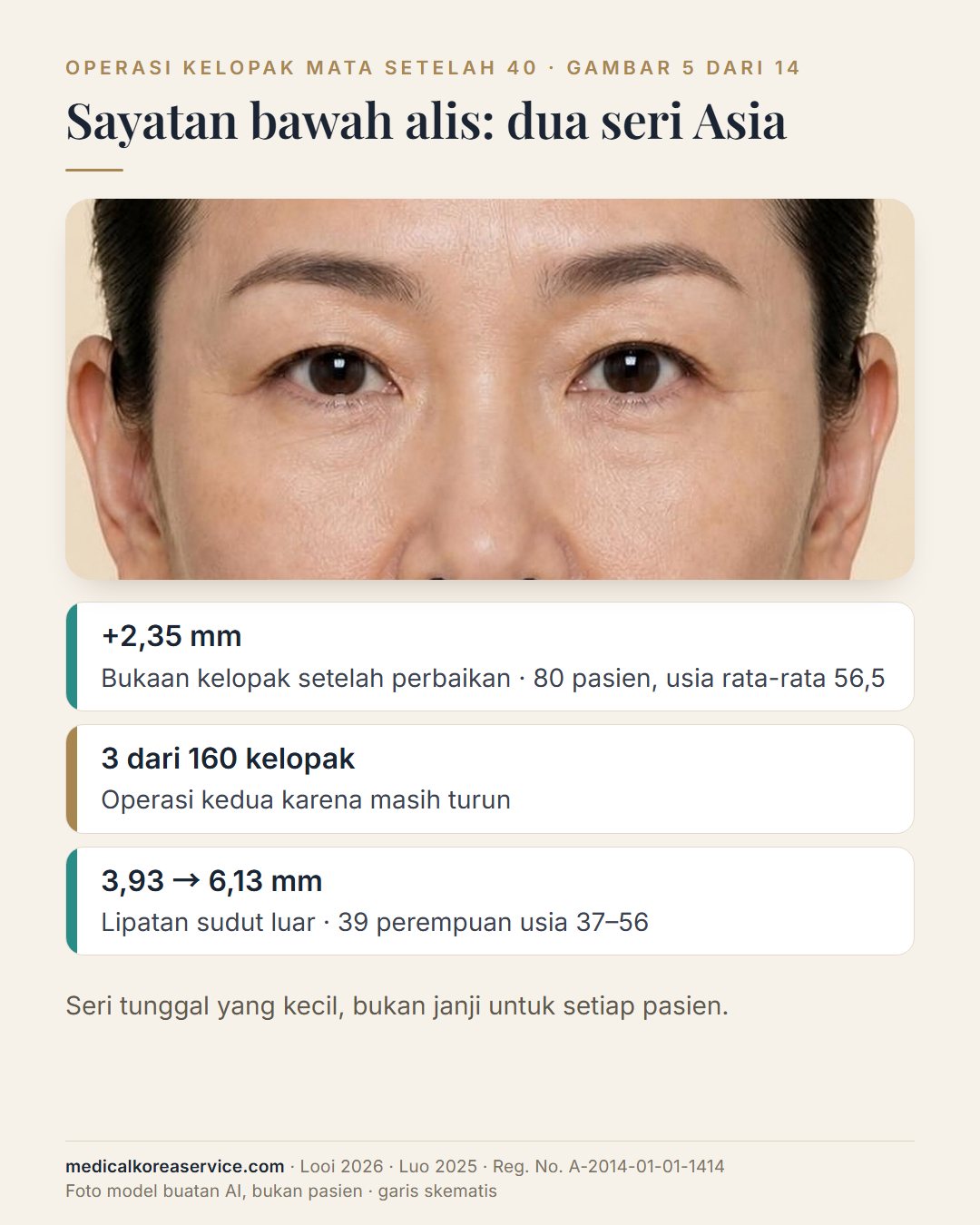 Foto model buatan AI. Tiga hasil operasi sayatan bawah alis pada pasien Asia di samping potret: bukaan kelopak bertambah 2,35 mm pada 80 pasien, 3 dari 160 kelopak dioperasi ulang, lipatan sudut luar dari 3,93 menjadi 6,13 mm pada 39 perempuan