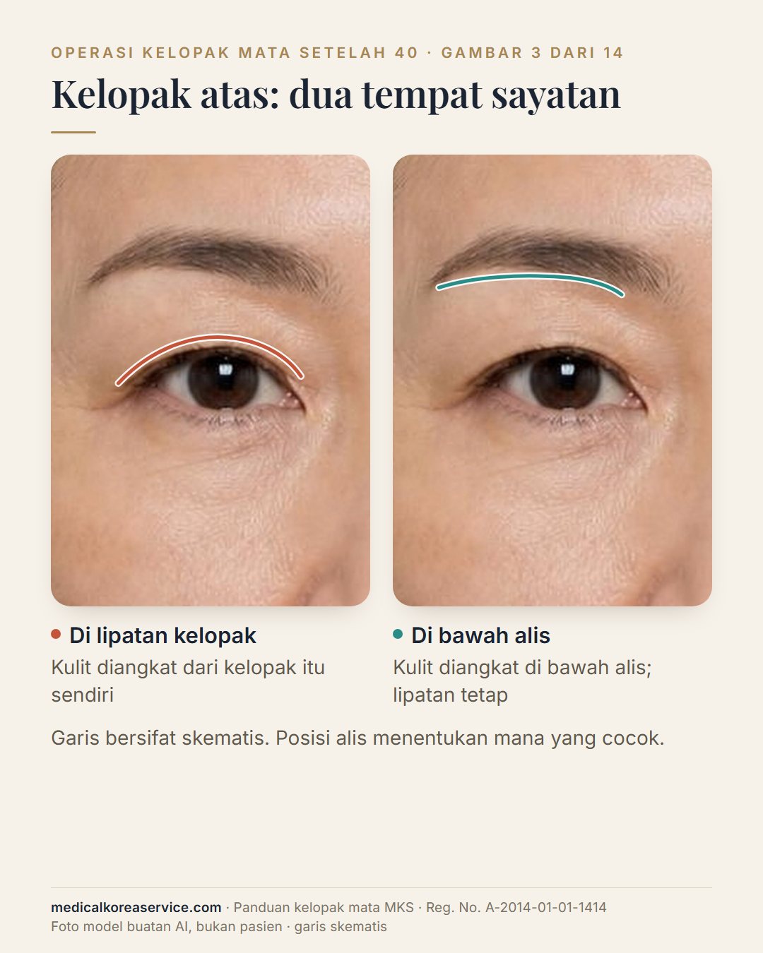 Foto model buatan AI. Dua tampilan mata yang sama membandingkan letak sayatan kelopak atas: garis di lipatan kelopak dan garis tepat di bawah alis