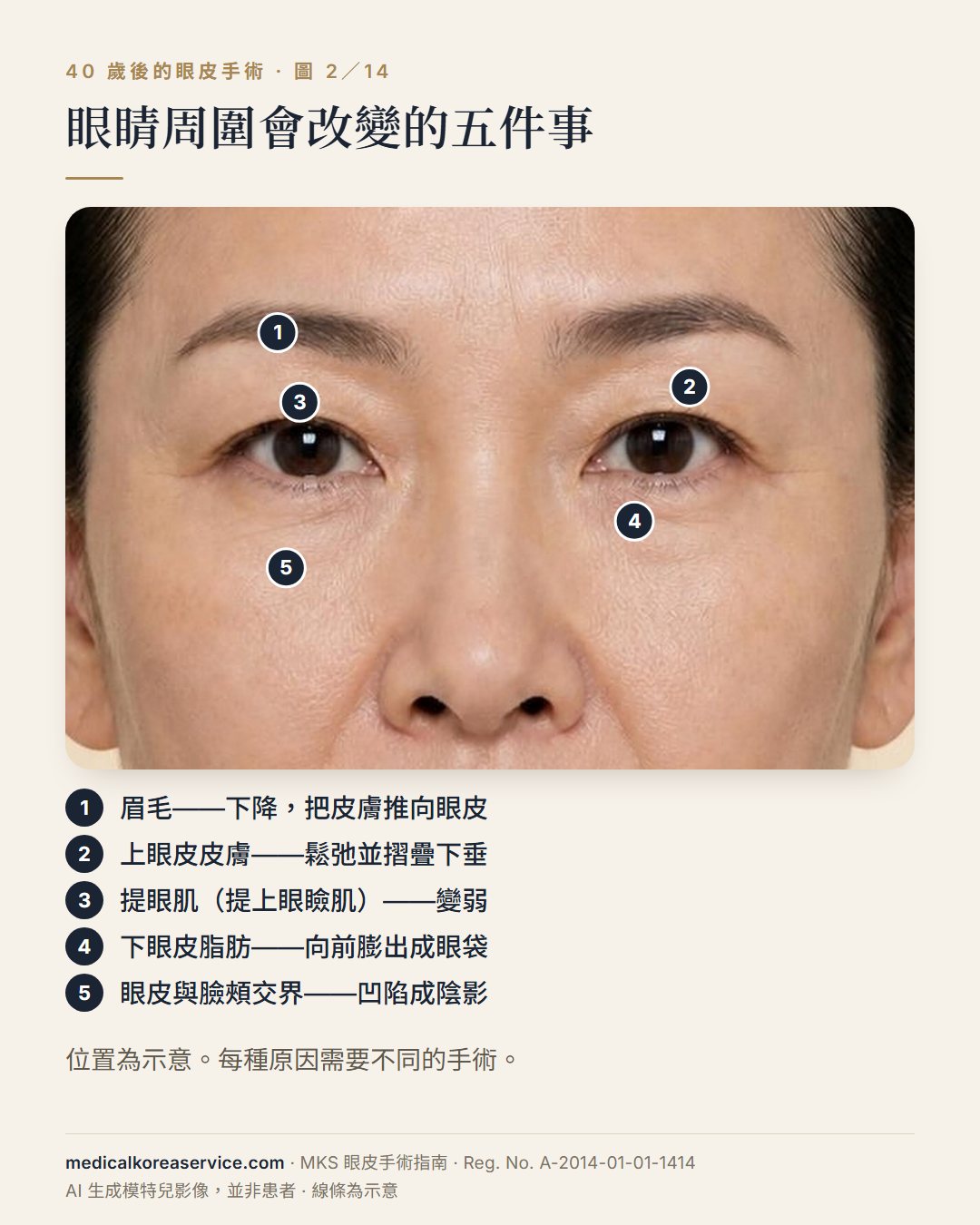 AI 生成的模特兒照片。眼睛近照與五個編號：眉毛、上眼皮皮膚、提上眼瞼肌、下眼皮脂肪、眼皮與臉頰交界