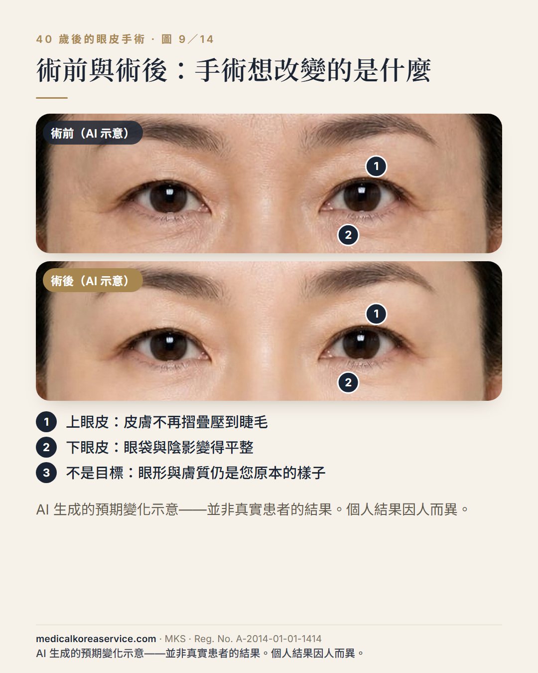 AI 生成的模特兒照片。同一位模特兒雙眼的兩張圖，標示術前與術後，上眼皮與下眼皮各有編號：上眼皮皮膚不再摺疊壓到睫毛，下眼皮的眼袋與陰影變得平整術前與術後影像為 AI 生成的預期變化示意，並非真實患者的結果。