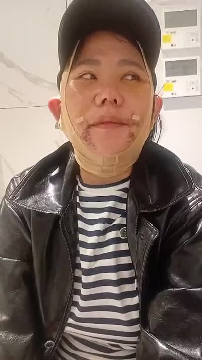 Imelda, Chinese-Indonesian patient — Facelift & Nose Surgery in Korea, video review
